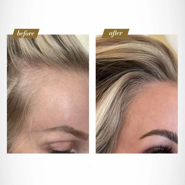 Velyra™ Roller Therapie
